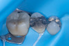 (32.) Intraoral view showing a fractured buccal cusp of the mandibular second premolar.