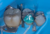 (33.) Amalgam surface prepared for sandblasting to improve mechanical retention. The adjacent dentin is protected with liquid dam to prevent contamination by amalgam particles, which could otherwise cause staining and interfere with hybrid layer formation.