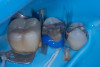 (34.) Application of the selective etching technique, with phosphoric acid applied only to the enamel surface, leaving the dentin unetched.