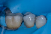 (39.) Fractured cusp after adhesive bonding and polishing of the finish line, resulting in a smooth and seamless transition and 25-month follow up radiograph where the adhesively bonded fracture line is visible.