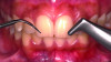Fig 1. Ultrasonic scalers and air polishing devices are commonly employed during routine prophylaxis and periodontal therapy. Care must be taken to minimize the risk of damaging restorations.