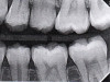 Fig 12. Six-month results of SDF proximal surface saturation in a teenaged patient. As seen in pretreatment bitewing film (Fig 12) and 6-month post-SDF bitewing films (Fig 13 and Fig 14), proximal radiolucencies appeared unchanged while some improved.