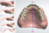 (12.) Virtual design of the maxillary denture demonstrating ideal thickness of the printed denture base at the various teeth on the denture.