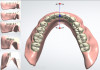 (13.) Virtual design of the mandibular denture demonstrating ideal thickness of the printed denture base at the various teeth on the denture.