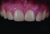 Fig 1. Preoperative intraoral view showing a retained deciduous maxillary left lateral incisor with high mobility and advanced root resorption.
