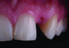 Fig 5. Soft-tissue healing and pontic site development after connective tissue grafting and interim prosthesis wear.
