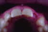 Fig 6. Occlusal view of the shaped pontic site.