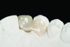 Fig 10. Palatal view of the RBFDP on the model showing the single retainer wing and its adaptation to the abutment tooth preparation.