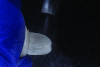 Fig 12. APC concept, step “A”: airborne-particle abrasion of the intaglio surface of the retainer wing using 50-µm Al2O3 particles at 1 bar pressure in preparation for bonding.