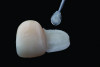 Fig 13. APC concept, step “P”: application of the MDP-containing ceramic primer immediately following airborne-particle abrasion.
