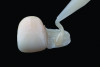 Fig 14. APC concept, step “C”: application of dual- or self-cure resin-based composite cement.