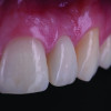 Fig 17. Postoperative close-up view of the completed restoration highlighting the pontic emergence profile and soft-tissue adaptation at the augmented ridge site.