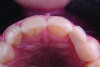 Fig 18. Postoperative occlusal view of the bonded retainer wing showing complete seating and marginal adaptation of the RBFDP on the abutment tooth.