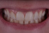 Fig 19. Final extraoral photograph demonstrating the esthetic outcome and the patient’s smile.