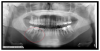 Fig 2. Panoramic radiograph taken on a follow-up visit exhibiting idiopathic osteosclerosis on the opposing side (noted in red). Idiopathic osteosclerosis noted in red. No pathology for numbness noted for the left side.