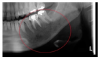 Fig 4. An enlarged section of the presurgical panoramic radiograph, taken 5 months after initial complaints of numbness. Affected area noted in red circle.