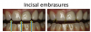 Fig 9. Evaluation of the incisal embrasures.