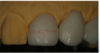 Fig. 23. The red wax line was at the same level as tooth No. 8.