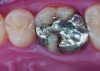 Figure 9 Preoperative preparation with composite block-out restoration, final cementation of Class IIb material, and final ceramic contour and stain by Steve Lee, CDT, MDC.