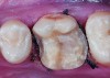 Figure 10 Preoperative preparation with composite block-out restoration, final cementation of Class IIb material, and final ceramic contour and stain by Steve Lee, CDT, MDC.