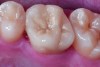 Figure 11 Preoperative preparation with composite block-out restoration, final cementation of Class IIb material, and final ceramic contour and stain by Steve Lee, CDT, MDC.