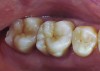 Figure 17 Image of two-molar full-crown porcelain-fused-to-metal restoration made with a CL-IV (CAPTEK) substrate.