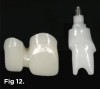 Fig 12. An all-ceramic custom CAD/CAM–fabricated abutment was made for implant No. 8 and splinted crowns for tooth No. 7 joined to implant No. 8. The splinted zirconium dioxide framework is shown.
