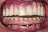 Fig 8. Five-year follow-up. Severe wear. Some chipping of ceramic facings of upper anterior PFM restorations against lower denture teeth. Wear changes incisal relationship from a Class I to end-to-end occlusion.