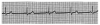 Figure 7. Sinus bradycardia. Each cycle commences with a P wave and the PR interval is normal. Therefore, rhythms are sinus-paced and differ only in rate: normal sinus rhythm, sinus bradycardia, or sinus tachycardia. In this case, it is sinus bradycardia, because the rate is <60.