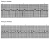 Figure 14. Normal sinus rhythm with second-degree (Mobitz) atrioventricular block. Each cycle commences with a P wave, but occasionally the P wave is not followed by a QRS and another P wave appears. This is called a ‘‘dropped beat’’ and is the fundamental defect in a second-degree or Mobitz block. First look at tracing A. (Don’t be disturbed by the fact that the QRS complexes go down instead of up. Waves are waves! Their direction depends on the particular lead used to record the tracing.) Notice that each successive PR interval lengthens until finally one P wave stands alone and a beat is dropped. Also notice that after the beat is dropped, the PR intervals commence again to progressively lengthen until another beat is dropped. This strange pattern of PR intervals was first described by a cardiologist named Wenckebach. Therefore, this type of second-degree block is called a Mobitz 1 or Wenckebach block. In tracing B, notice that all PR intervals are identical. They may be normal in length or delayed, but they are all the same; even after a beat is dropped, they resume their duration. This is called a Mobitz 2 block. In this particular example, the ratio of P waves to QRS complexes is 2:1. Therefore, the R-R intervals are regular. With any other ratio, eg, 3:1 or 4:1, the R-R interval would appear irregular.