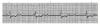 Figure 17. Third-degree (complete) block. There are P waves but the PR intervals appear inconsistent; no pattern is repeated. If impulses were being conducted into the ventricles, the R-R intervals would be irregular and the QRS complexes would be narrow. Neither is the case, however; the R-R intervals are regular and the complexes are slightly widened. (They get wider and wider according to the location of the ventricular pacemaker. In this case, the pacer is probably in the bundle of His, because the complex is relatively narrow.) On closer analysis, one can detect that intervals between P waves (P-P intervals) are consistent and that R-R intervals are consistent. The only explanation is that the SA node is pacing the atria but impulses are not reaching the ventricles. Therefore, the ventricles have developed their own pacemaker and we have a complete (third-degree) heart block.