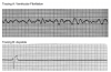 Figure 19. Ventricular fibrillation and asystole. Here we have the worst tracings of all. Tracing A is pure chaos with no consistent waves whatsoever—ventricular fibrillation. In tracing B, following a single beat, we have no further evidence of electrical activity. This is called asystole. In either case, the patient is in cardiac arrest with no pulse.