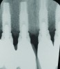 Fig 1 through Fig 6. Periapical radiographs of a 52-year-old man who received a fixed porcelain-fused-to-metal reconstruction supported by abutments attached to externally hexed dental implants. Fig 1 through Fig 3 are at initial prosthesis placement: maxillary right (Fig 1), textured surfaced threaded titanium implants at site Nos. 2, 4, and 6; maxillary anterior (Fig 2), implants at site Nos. 7 through 9; maxillary left (Fig 3), implants at site Nos. 12 and 14. Fig 4 through Fig 6 are 10 years post-insertion of the prosthesis: maxillary right (Fig 4), maxillary anterior (Fig 5), and maxillary left (Fig 6). Note minimal to no bone loss radiographically around the implants 10 years post-insertion of prosthesis.