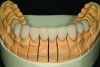 Fig 21.  The completed ceramic restorations on the mandibular master model are shown.