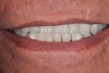 2. Potential “All-on-4” patient with terminal dentition who was unhappy with his smile esthetics.