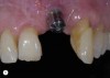 Fig 5. Removal of the restoration further reveals improper implant position from mesial, buccal, lingual, coronal, and angulation perspectives.