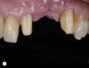 Fig 6. Pragmatism and insufficient space for placing two implants led to the selection of a tooth-supported restoration.