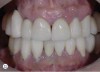 Fig 11. Clinical retracted view of the reconstruction. Notice the uneven gingival margins and the ill-fitting restorations.