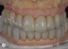 Fig 12 After all the teeth and some implants were extracted, a segmented, screw-retained, implant-supported reconstruction was fabricated and delivered.