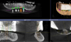 Fig. 4 The implants had to be placed in limited bone and avoid the mandibular nerve. The most predictable way to get the maximum number and size implants was with a virtual plan and surgical guide.