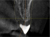 Fig. 8 There was a 20° deviation between the long axis of the implant and the access hole. Because a screw-retained crown was desired, a Straumann Bone Level implant was planned, which has an angled abutment that can accommodate a screw-retained crown.
