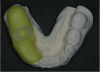 Fig. 16 through Fig. 18 The CEREC Guide was made in the office from a thermoplastic material (yellow). Initially, a radiographic insert (white) was embedded and placed in the mouth during the CBCT scan. After the implant was planned, a drill guide (clear) was milled and inserted into thermoplastic housing. The guide was ready for surgery.