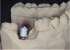 Fig. 27 and Fig. 28 Intraoral and extraoral CAD/CAM impression copings ready to optically scan.