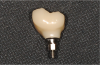 Fig. 35 through Fig. 37 A screw-retained crown, a custom abutment and crown, and the final screw-retained crown.