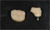 Fig. 35 through Fig. 37 A screw-retained crown, a custom abutment and crown, and the final screw-retained crown.