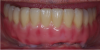 Fig. 38 through Fig. 40 A zirconium bridge was copy-milled. Zirconium was stained and glazed and 1 mm to 2 mm of porcelain was layered to the incisal and occlusal surface.