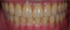 Fig. 38 through Fig. 40 A zirconium bridge was copy-milled. Zirconium was stained and glazed and 1 mm to 2 mm of porcelain was layered to the incisal and occlusal surface.