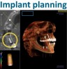 Figure 4 Complex treatment planning in the author’s office starts with converting the CBCT data to a DICOM format so that a third-party implant planning software, either Anatomage or Simplant Pro, can be used. After the treatment plan is presented and accepted by the patient, a surgical guide is ordered directly via the software. The surgery is performed. After 4 months, the implants are exposed. BIOMET 3i™ Encode© abutments (http://biomet3i.com) are placed and seating is verified with x-rays. The Encode abutments are scanned with the Cadent iTero© unit (Align Technology; www.itero.com) and the 3D images are sent electronically to Biomet 3i to make the custom titanium abutments and the all-zirconia milled three-unit bridges. The patient leaves with the Encode abutments and returns in a couple of weeks for the delivery of the abutments and bridges.