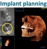 Figure 5 Complex treatment planning in the author’s office starts with converting the CBCT data to a DICOM format so that a third-party implant planning software, either Anatomage or Simplant Pro, can be used. After the treatment plan is presented and accepted by the patient, a surgical guide is ordered directly via the software. The surgery is performed. After 4 months, the implants are exposed. BIOMET 3i™ Encode© abutments (http://biomet3i.com) are placed and seating is verified with x-rays. The Encode abutments are scanned with the Cadent iTero© unit (Align Technology; www.itero.com) and the 3D images are sent electronically to Biomet 3i to make the custom titanium abutments and the all-zirconia milled three-unit bridges. The patient leaves with the Encode abutments and returns in a couple of weeks for the delivery of the abutments and bridges.