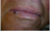 Figure 4 Preoperative view of the capillary hemangioma of the lip. The lesion is a 5-mm x 5-mm round, slightly exophytic nodule with a smooth surface and is bluish-purple in color.
